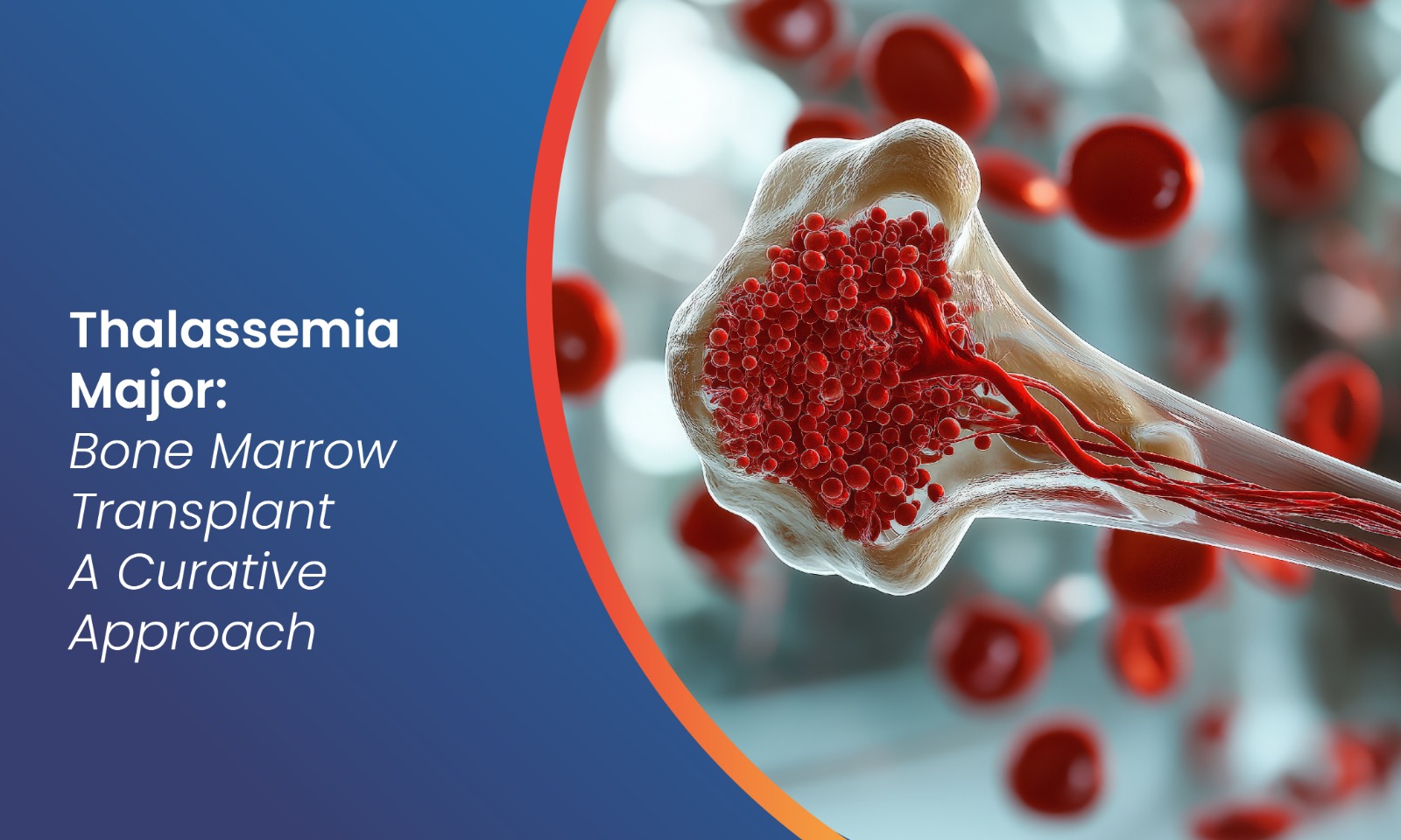 Bone Marrow Transplant for Thalassemia Treatment Guide