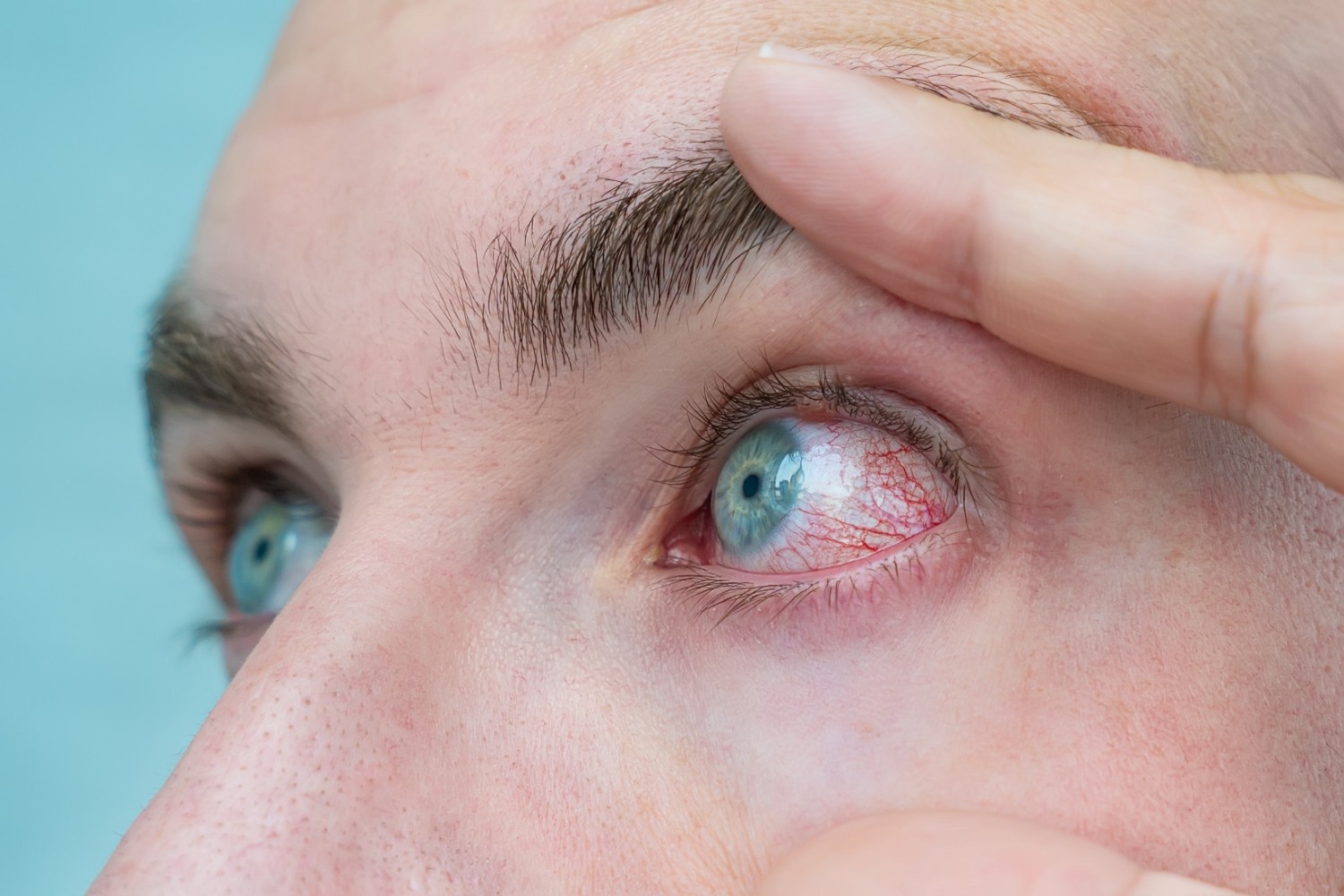 Glaucoma